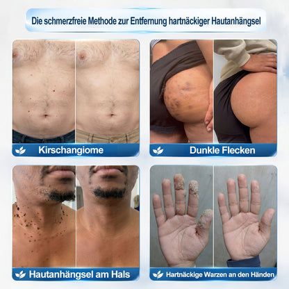 Offizieller Markenstore |✅𝑷𝑖𝒄𝐝𝐨® 7-𝑻𝒂𝒈𝒆 𝑯𝒂𝒖𝒕𝒂𝒏𝒉ä𝒏𝒈𝒔𝒆𝒍- & 𝑭𝒍𝒆𝒄𝒌𝒆𝒏𝒆𝒏𝒕𝒇𝒆𝒓𝒏𝒆𝒓(Schmerzfreier Rollerball – Keine Narbenbildung)🌺
